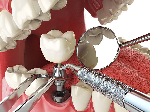 Best Broken or Chipped Tooth Repair in Briarcliff Manor, NY